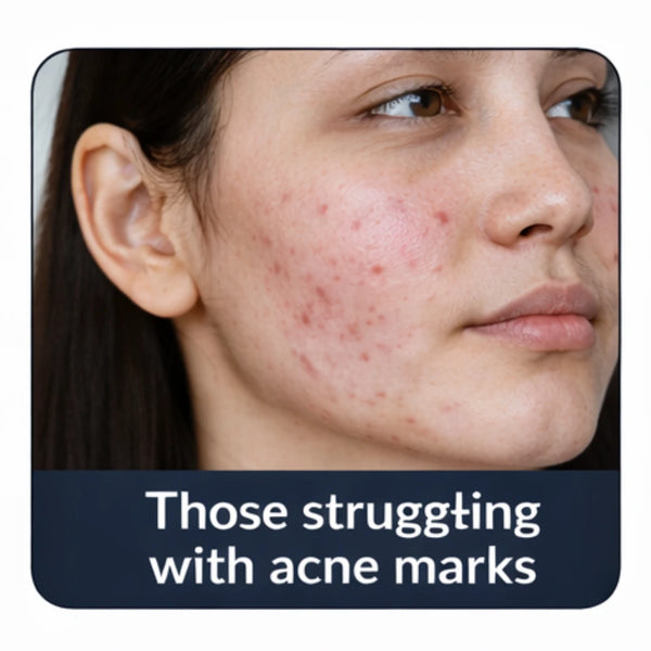 Person with acne on their face, with text indicating those struggling with acne marks.